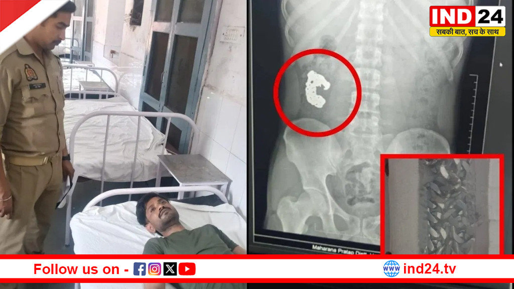 बरेली: सबूत मिटाने के लिए चोर ने निगला चांदी का ब्रेसलेट, X-Ray ने खोला सारा राज