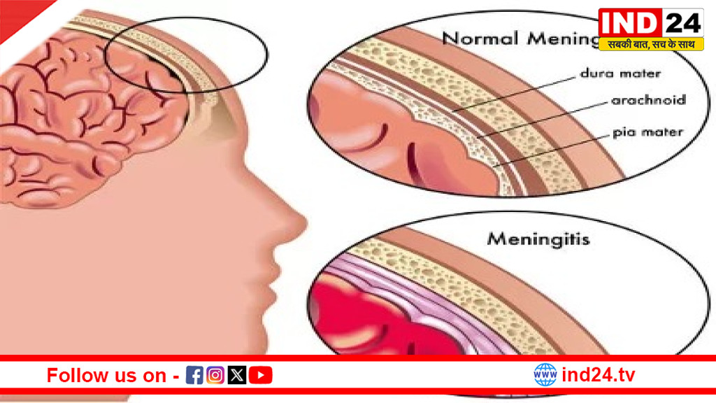 तेज़ गर्मी और प्रदूषण में बढ़ता बैक्टीरियल मेनिन्जाइटिस का खतरा — क्या है यह और कैसे रहें सुरक्षित