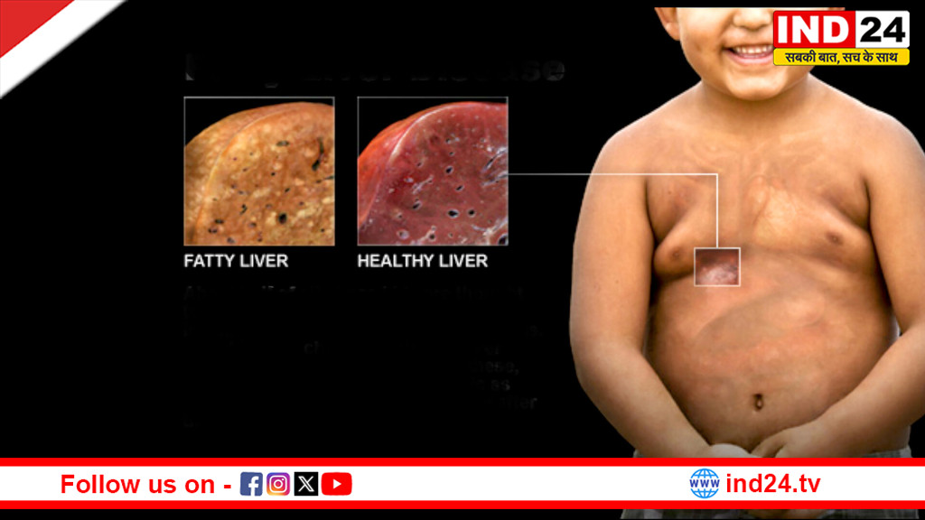 विश्व स्वास्थ्य दिवस 2026: बच्चों में बढ़ता फैटी लिवर बना नई चिंता, विशेषज्ञों ने दी चेतावनी