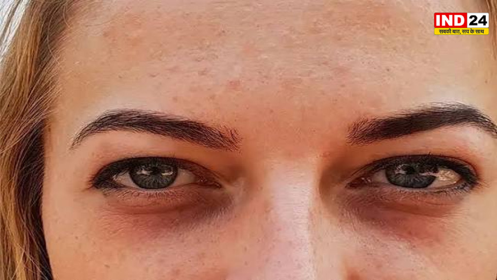 आंखों के नीचे सूजन और डार्क सर्कल बढ़ रहे हैं? गर्मियों में इन वजहों से बिगड़ सकती है Eye Health