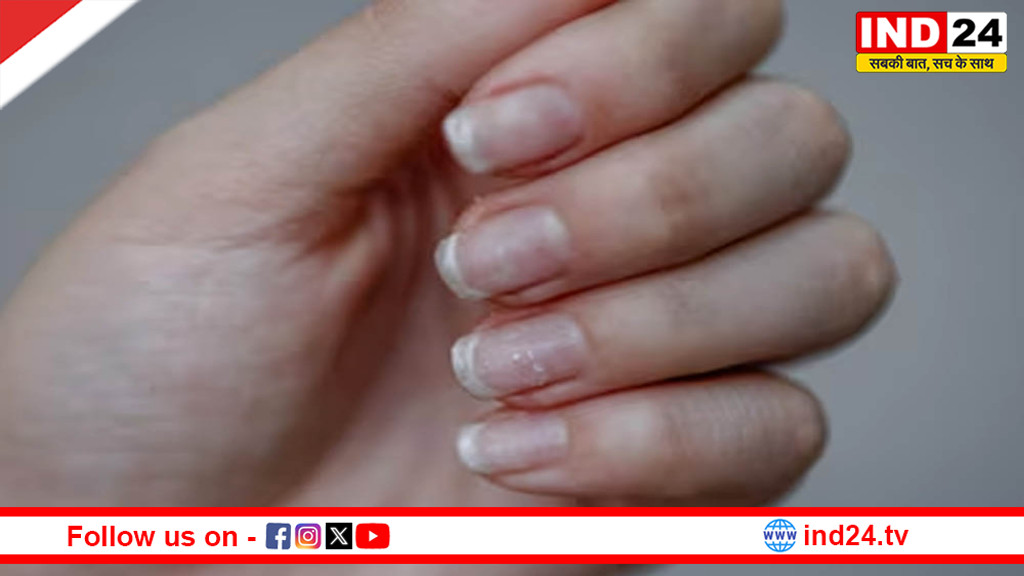 नाखूनों में सफेद निशान को न करें नजरअंदाज, हो सकती है ये बीमारी