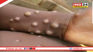  मंकीपॉक्स से कहीं कोरोना जैसे हालात न हो जाएं… निपटने के लिए इंदौर में तैयारी शुरू, बनेगा अलग वार्ड