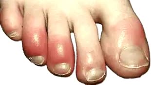 Winter Care: ठंड में पैरों की उंगलियों में हो रही है सूजन, तो अपनाएं से टिप्स