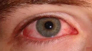 चंपावत में तेजी से फैल रहा आई फ्लू, अस्पतालों में लगी लंबी मरीजों की लाइन