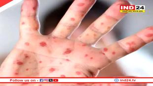 देश में मिला मंकीपॉक्स का नया मामला, ये है संकेत