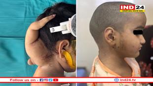 AIIMS में जटिल सर्जरी, 3 साल की बच्ची के सिर और गर्दन से अविकसित ‘जुड़वां बच्चा’ हटाया