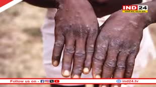 भारत में भी मंकीपॉक्स की एंट्री! विदेश से लौटे शख्स में मिले लक्षण, आइसोलेट किया गया