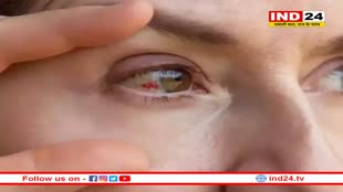 तेजी से बढ़ रहा आई फ्लू का खतरा, जानें क्या है इस फ्लू के लक्षण और बचाव के तरीके