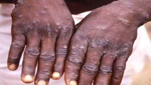 कर्नाटक में मिला मंकीपाक्स का केस, दुबई से आया शख्स संक्रमित