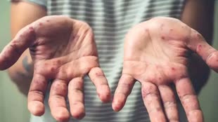 छत्तीसगढ़ में मंकी पॉक्स को लेकर एडवाइजरी जारी, हर गावों में लगेंगे कैंप