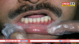 4 स्टेप में मुंह खोलकर देखिए, नहीं खुल रहा तो हो सकता है कैंसर !