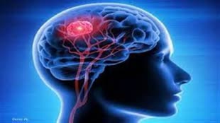 ठंड बढ़ने के साथ बढ़े ब्रेन स्ट्रोक के मामले, हर दिन 6 मरीज हो रहे भर्ती, ऐसे करें बचाव