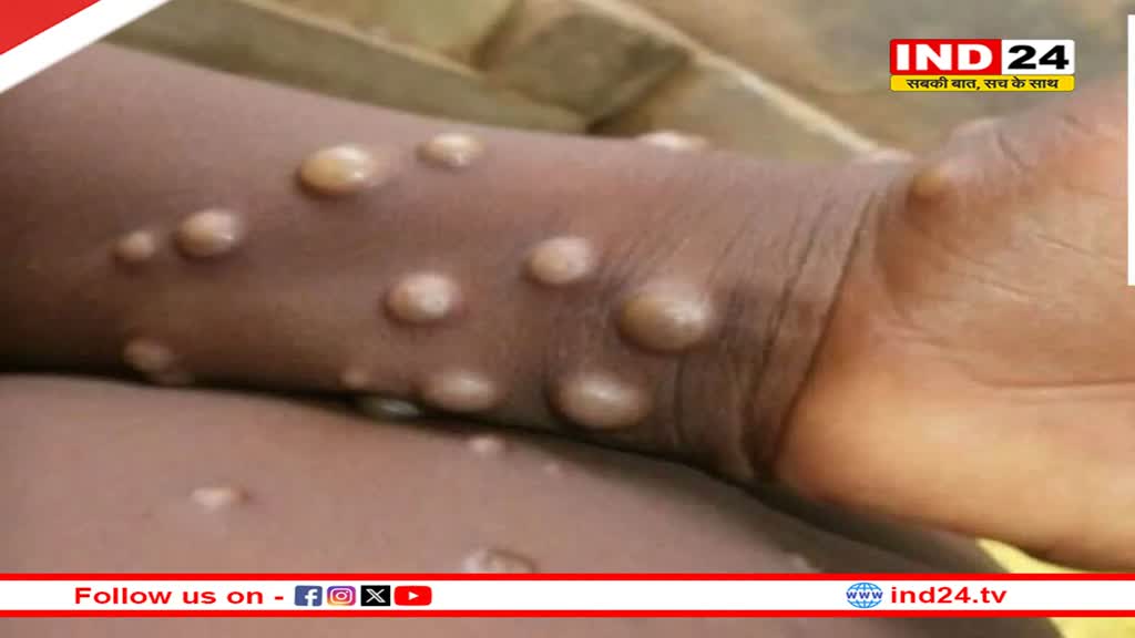  मंकीपॉक्स से कहीं कोरोना जैसे हालात न हो जाएं… निपटने के लिए इंदौर में तैयारी शुरू, बनेगा अलग वार्ड
