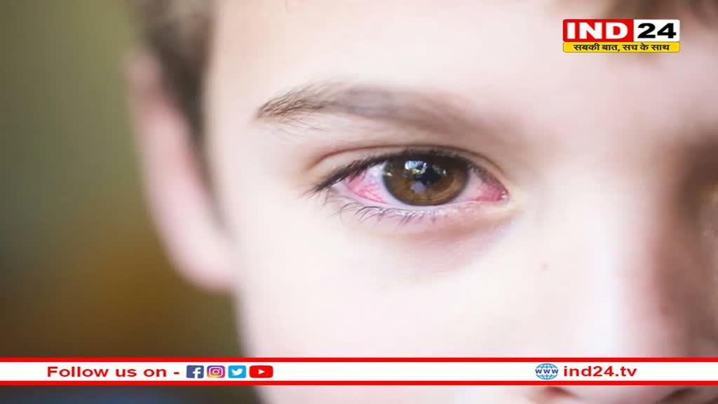 Eye Flu: बड़े ही नहीं बच्चों को भी अपनी चपेट में ले रहा है कंजंक्टिवाइटिस, ऐसे रखें उनका ध्यान