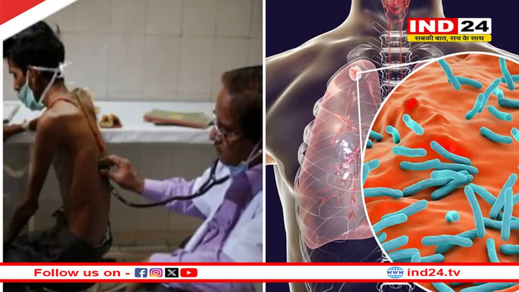   MP News: एमपी में टीबी के मरीजों में लगातार हो रहा इजाफा, प्रति लाख आबादी में करीब 216 ट्यूबर क्लॉसिस के मरीज