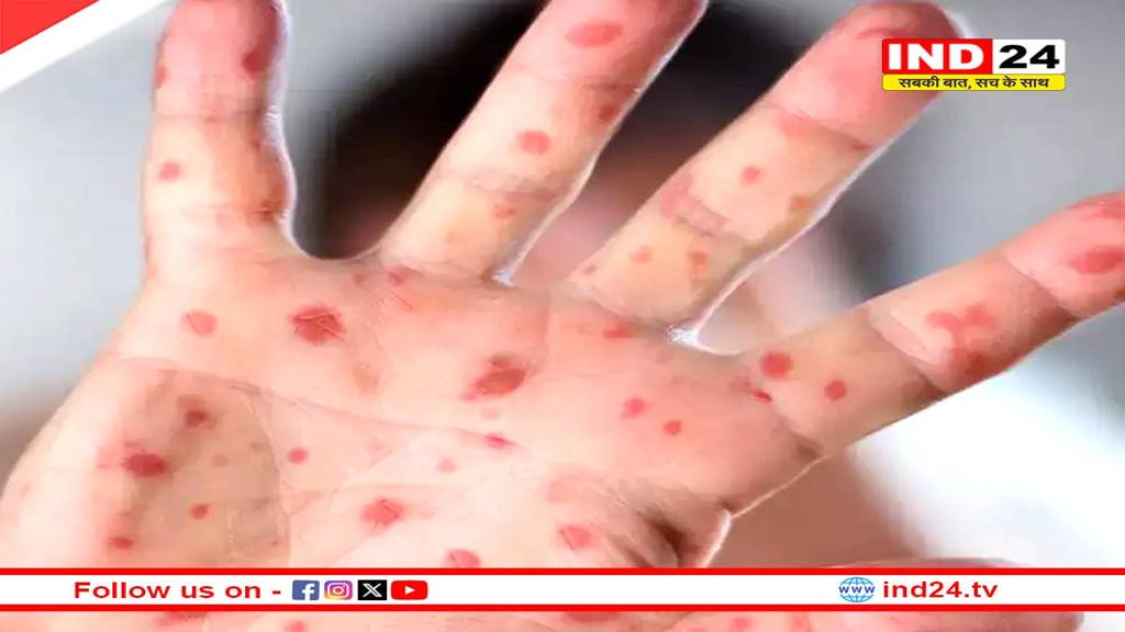देश में मिला मंकीपॉक्स का नया मामला, ये है संकेत