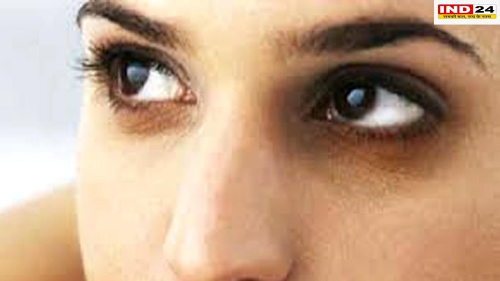 डार्क सर्कल से छुटकारा पाने के लिए अपनाएं ये उपाय