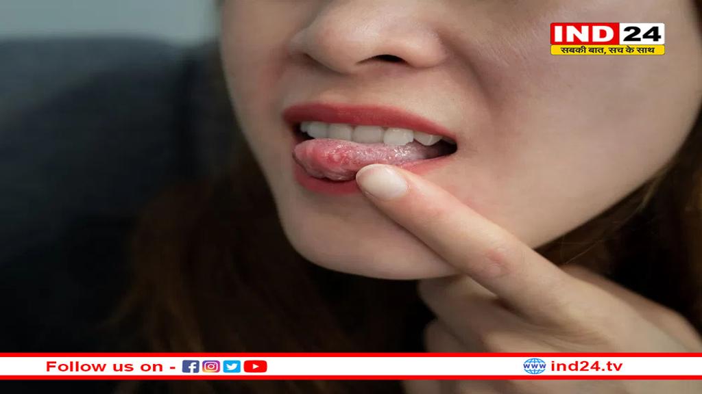 मुंह में लगातार रहते हैं छाले तो न करें नजरअंदाज, इन खतरनाक बीमारियों के हो सकते हैं लक्षण