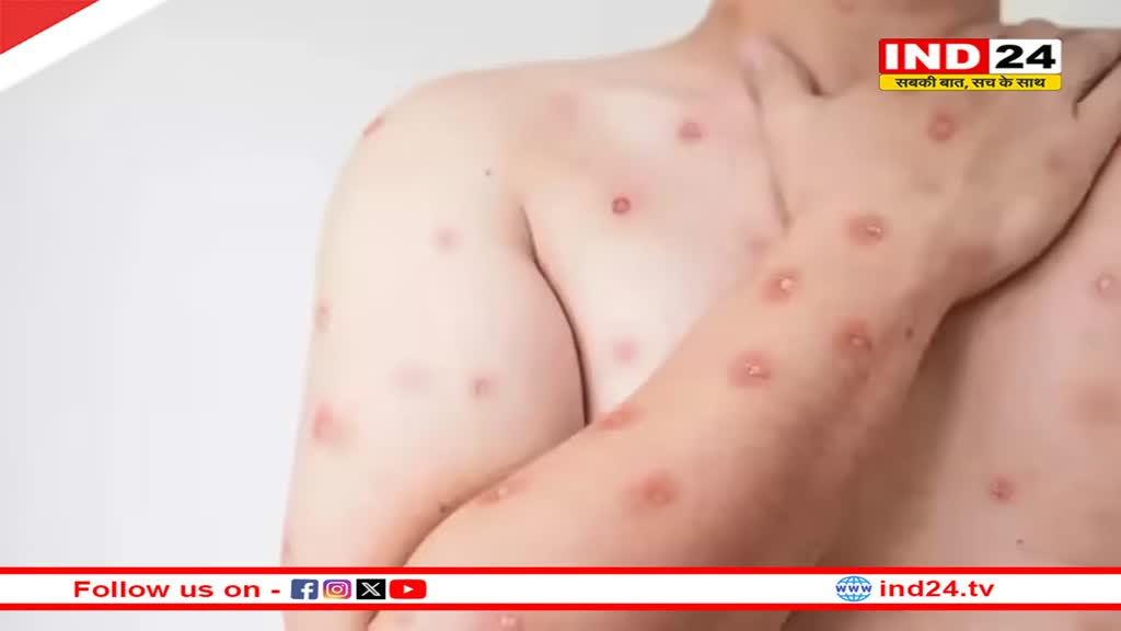 New MPox Variant: अफ्रीका के बाहर कई देशों में फैला नया एमपॉक्स वैरिएंट, इन देशों में हुई पुष्टी 