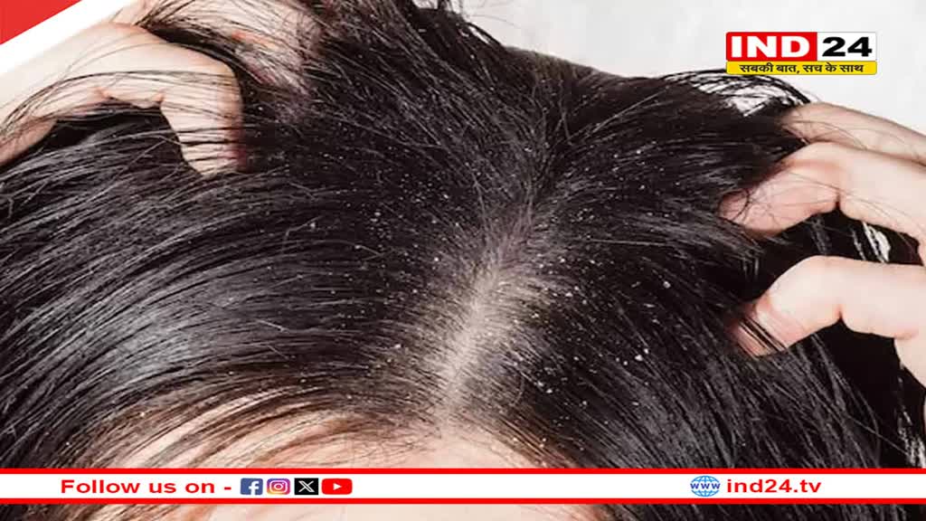 सर्दियों में ड्राई स्कैल्प से हैं परेशान, तो राहत पाने के लिए अपनाएं ये आसान उपाय