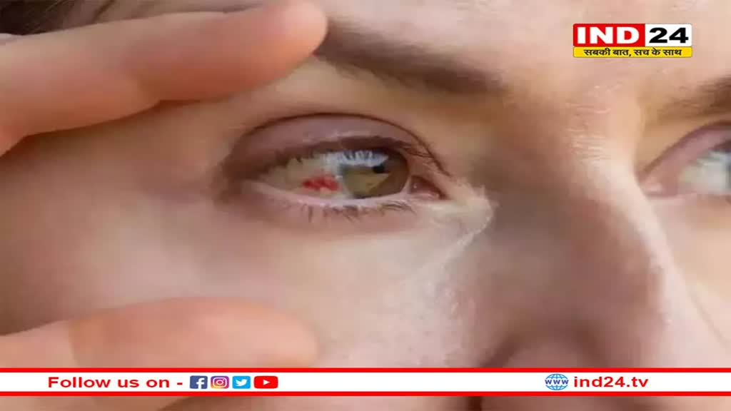 तेजी से बढ़ रहा आई फ्लू का खतरा, जानें क्या है इस फ्लू के लक्षण और बचाव के तरीके