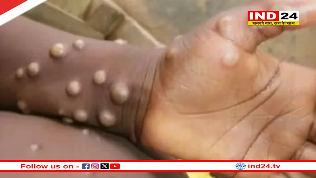 MPox की रोकथाम के लिए WHO ने शुरू की योजना, जानें क्या है इसके लक्षण? 