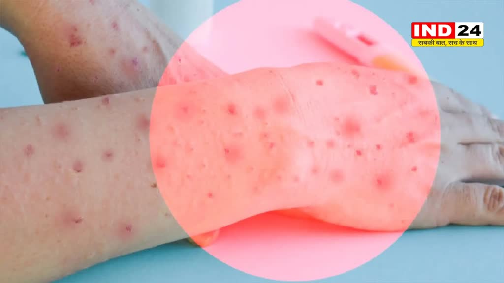 उज्जैन संभाग में टोमैटो फ्लू ने दी दस्तक, जानें लक्षण और बचाव के तरीके