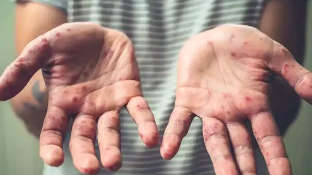 देश में मिला मंकीपॉक्स क्लेड-1 वेरिएंट का पहला मामला, WHO ने घोषित की वर्ल्ड इमरजेंसी