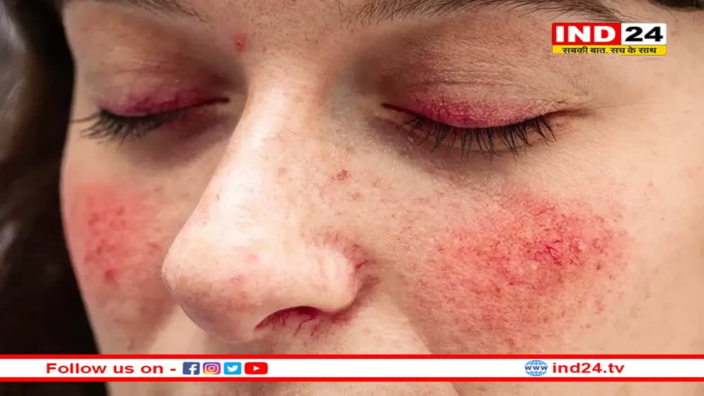 ठंड का मौसम त्वचा पर डालता है असर, सर्दियों में गाल लाल होने की समस्या को ऐसे करें दूर