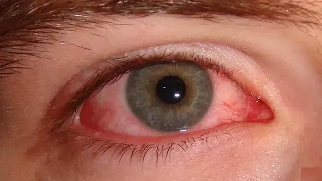 बारिश में सेहत, समस्याएं, समाधान