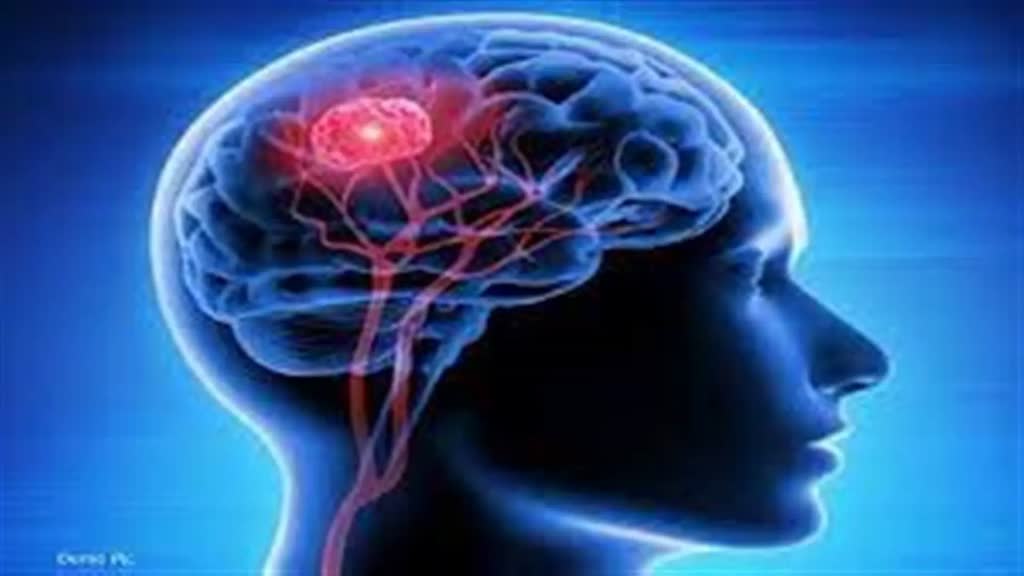 ठंड बढ़ने के साथ बढ़े ब्रेन स्ट्रोक के मामले, हर दिन 6 मरीज हो रहे भर्ती, ऐसे करें बचाव